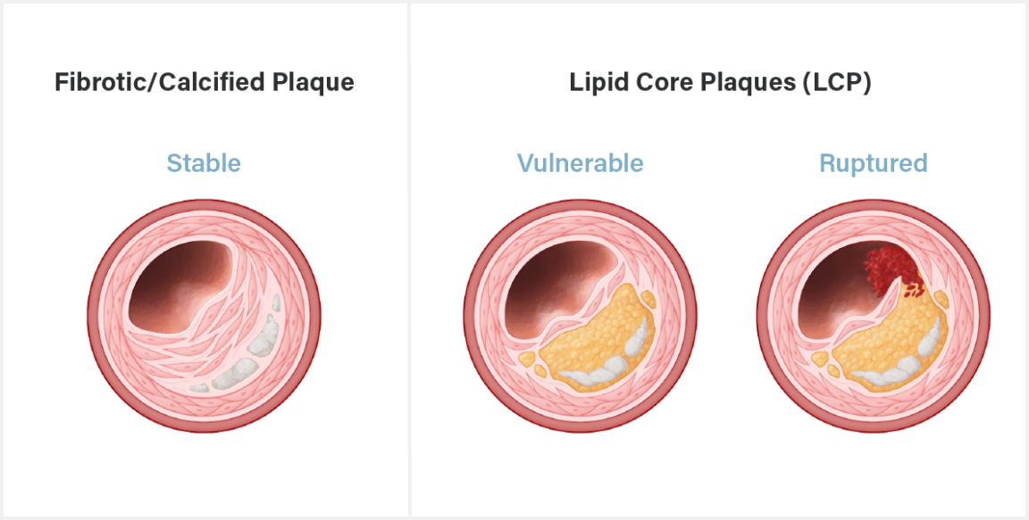 Coronary Artery Disease Infraredx